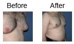 Male breast reduction case 2