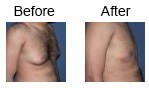 Male breast reduction case 4