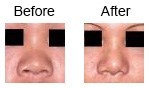 Rhinoplasty – nose corrections case 6