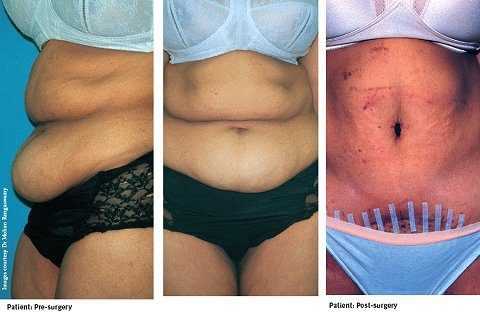 The tummy tuck with a difference