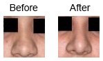 Rhinoplasty – nose corrections case 2