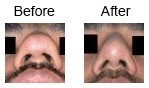 Rhinoplasty – nose corrections case 4
