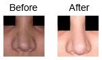 Rhinoplasty – nose corrections case 5