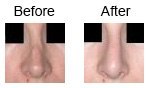Secondary Rhinoplasty – correction of Bad results