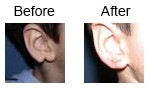Otoplasty-ear corrections: 2